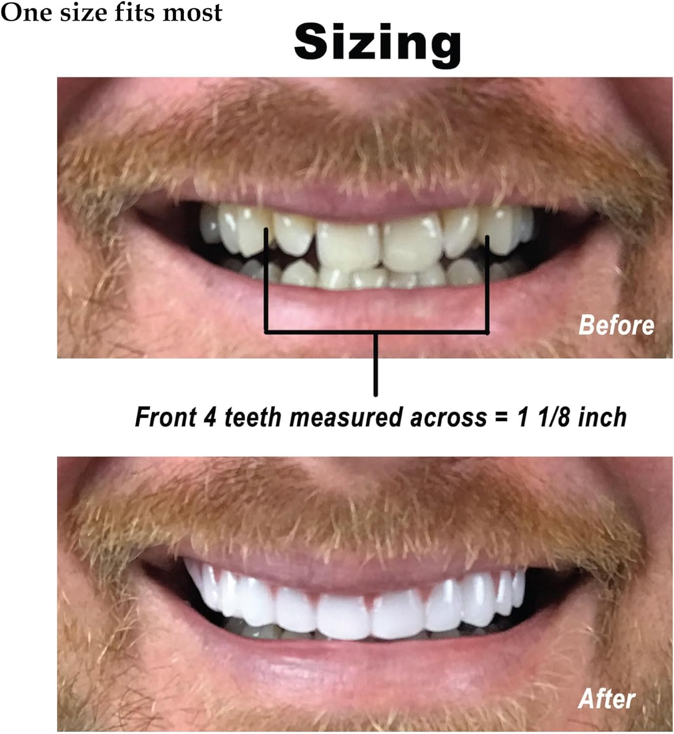 Instant Smile Comfort Fit Flex - Bright Shade - Upper Veneer Cosmetic Teeth